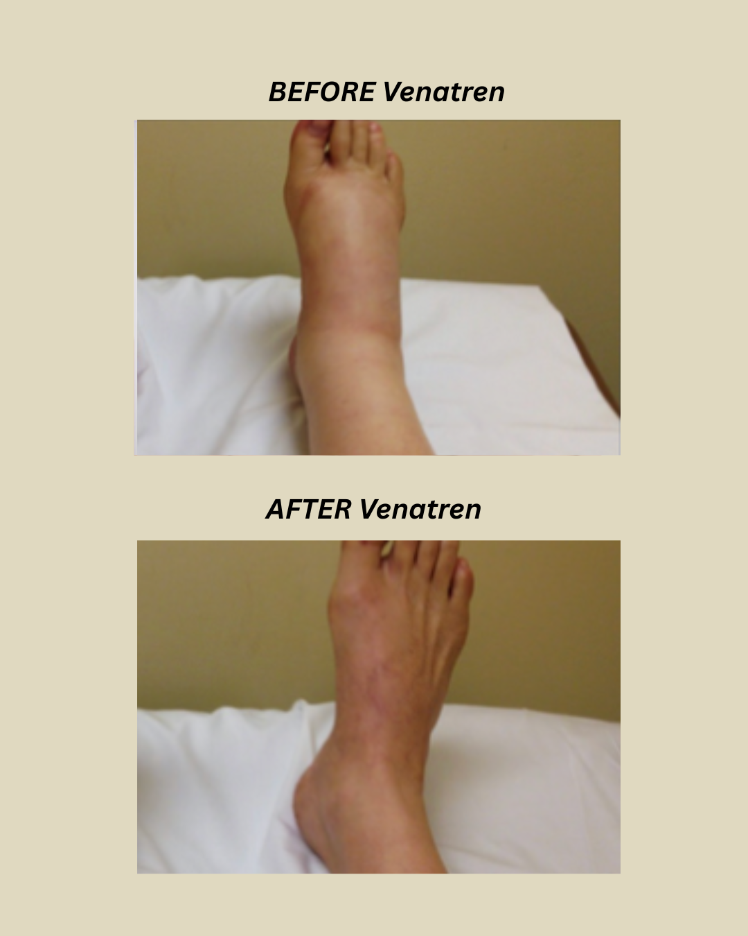 Venatren Bee Venom & Turmeric Arthritis Therapy Cream